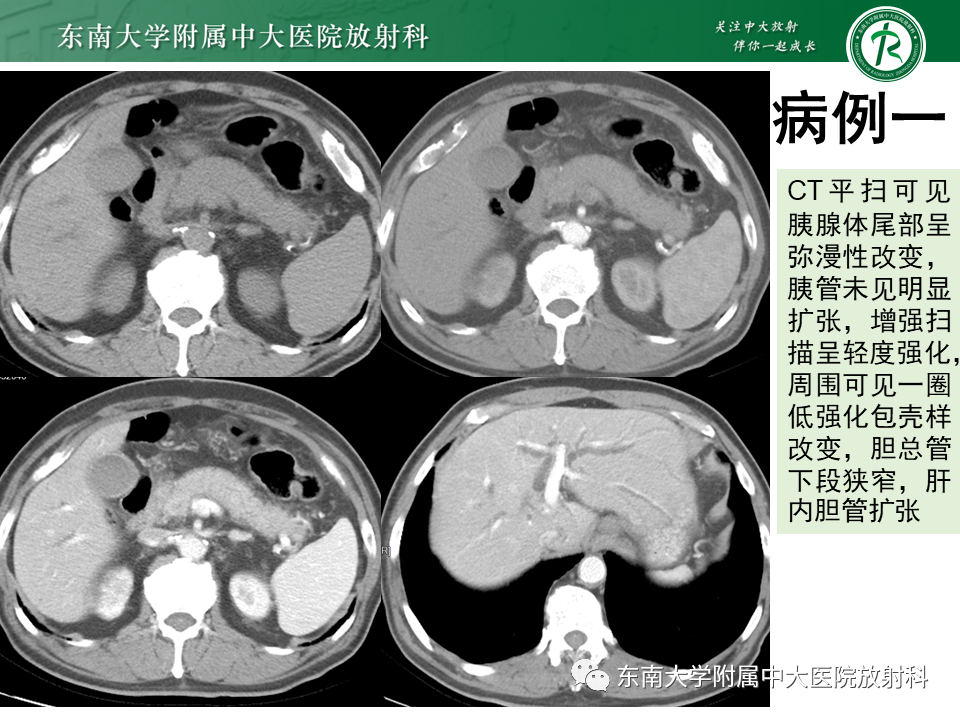 影像PPT - 【PPT】胰腺癌鉴别诊断-6 影像PPT - 【PPT】胰腺癌鉴别诊断-6