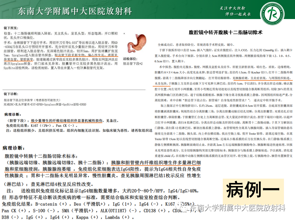 影像PPT - 【PPT】胰腺癌鉴别诊断-8 影像PPT - 【PPT】胰腺癌鉴别诊断-8