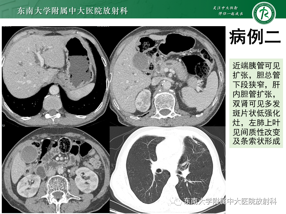 影像PPT - 【PPT】胰腺癌鉴别诊断-10 影像PPT - 【PPT】胰腺癌鉴别诊断-10
