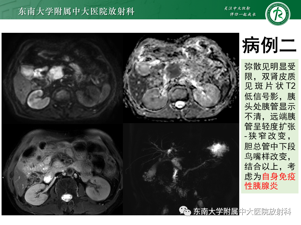 影像PPT - 【PPT】胰腺癌鉴别诊断-11 影像PPT - 【PPT】胰腺癌鉴别诊断-11
