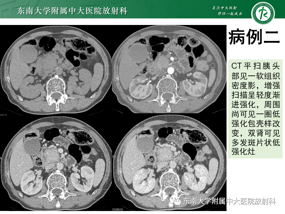影像PPT - 【PPT】胰腺癌鉴别诊断-9 影像PPT - 【PPT】胰腺癌鉴别诊断-9