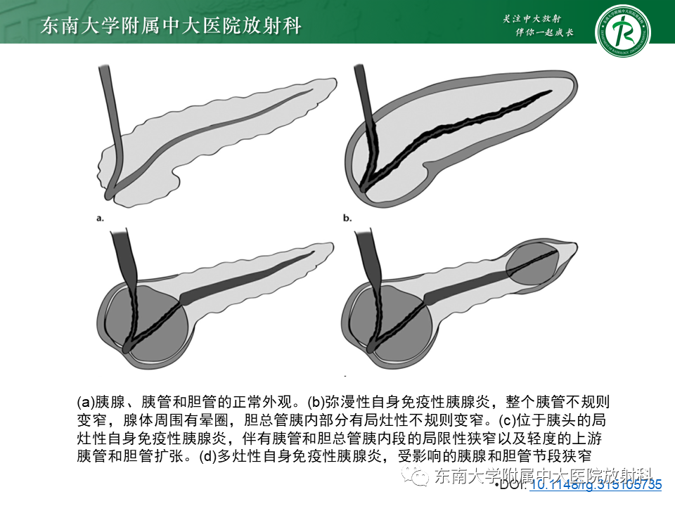 影像PPT - 【PPT】胰腺癌鉴别诊断-18 影像PPT - 【PPT】胰腺癌鉴别诊断-18