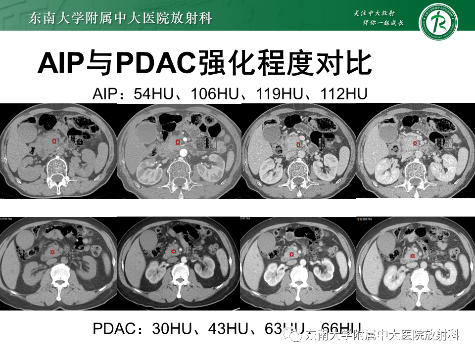 影像PPT - 【PPT】胰腺癌鉴别诊断-20 影像PPT - 【PPT】胰腺癌鉴别诊断-20