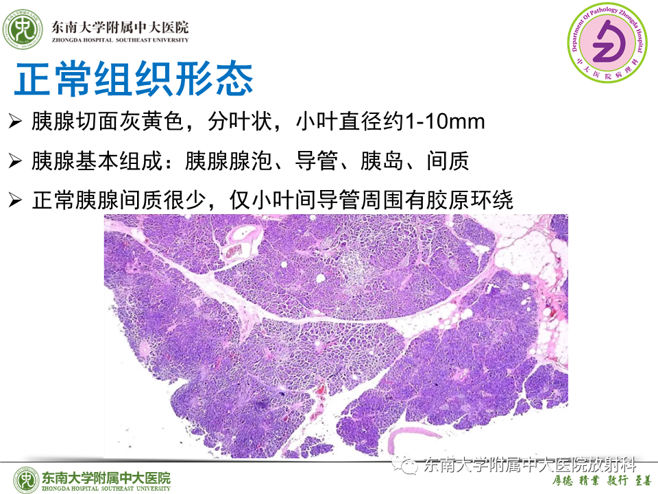 影像PPT - 【PPT】胰腺癌鉴别诊断-25 影像PPT - 【PPT】胰腺癌鉴别诊断-25