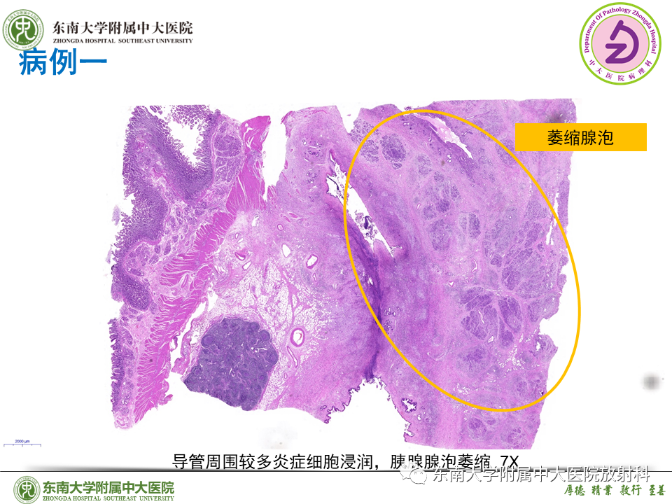 影像PPT - 【PPT】胰腺癌鉴别诊断-34 影像PPT - 【PPT】胰腺癌鉴别诊断-34