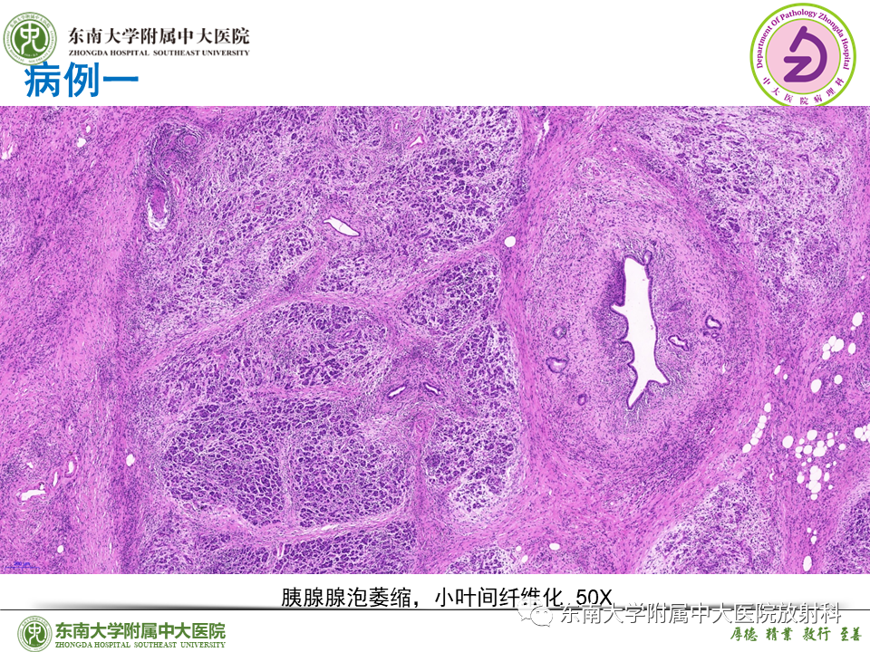 影像PPT - 【PPT】胰腺癌鉴别诊断-36 影像PPT - 【PPT】胰腺癌鉴别诊断-36