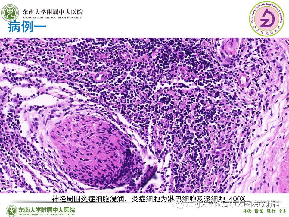 影像PPT - 【PPT】胰腺癌鉴别诊断-41 影像PPT - 【PPT】胰腺癌鉴别诊断-41