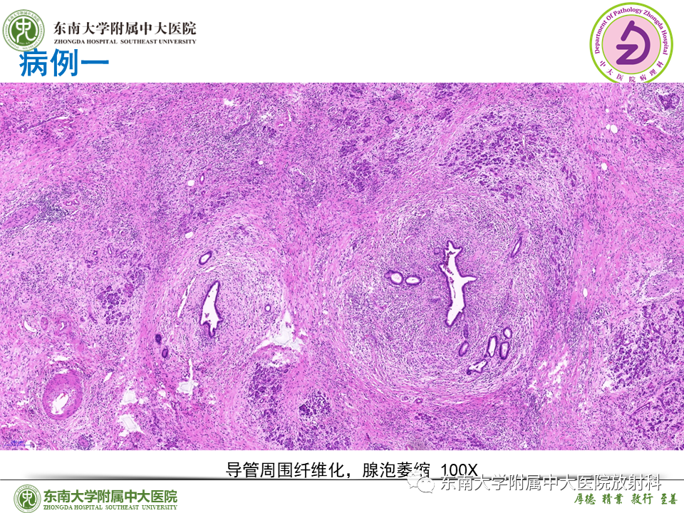 影像PPT - 【PPT】胰腺癌鉴别诊断-39 影像PPT - 【PPT】胰腺癌鉴别诊断-39