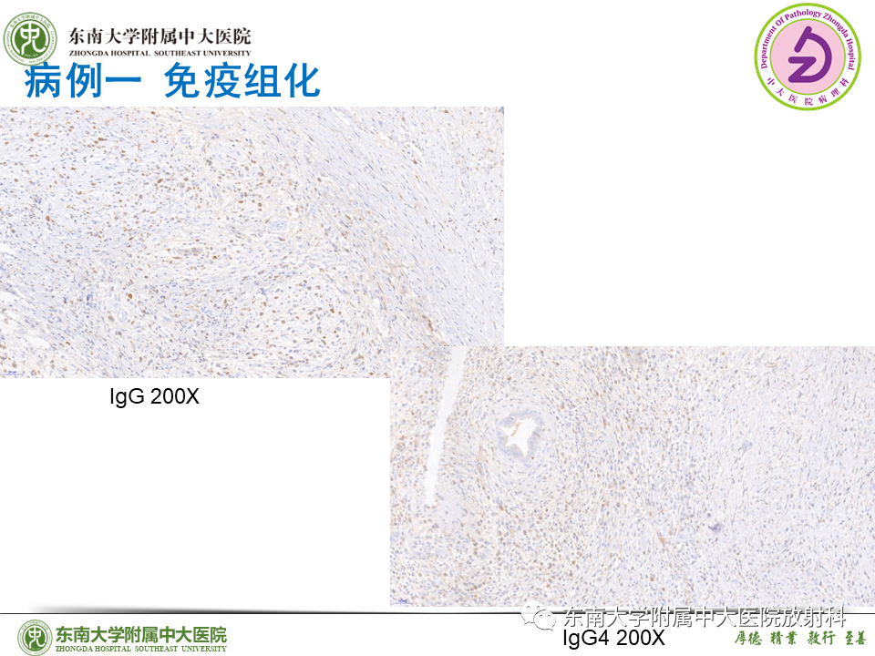 影像PPT - 【PPT】胰腺癌鉴别诊断-42 影像PPT - 【PPT】胰腺癌鉴别诊断-42