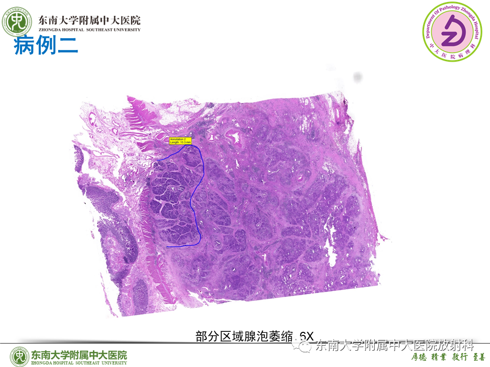 影像PPT - 【PPT】胰腺癌鉴别诊断-44 影像PPT - 【PPT】胰腺癌鉴别诊断-44