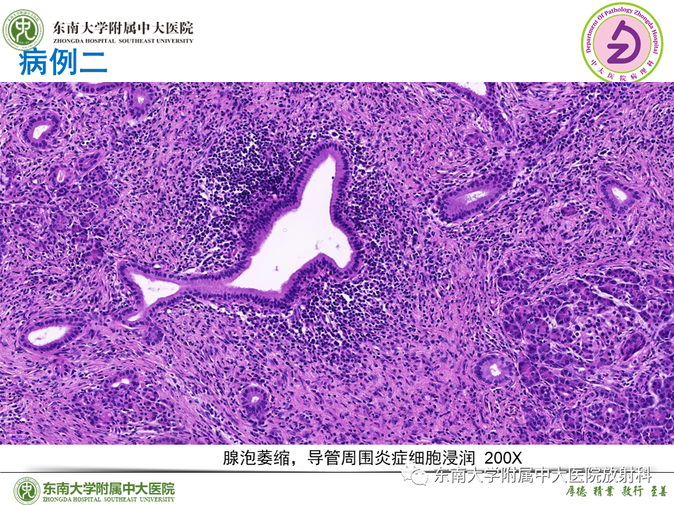 影像PPT - 【PPT】胰腺癌鉴别诊断-46 影像PPT - 【PPT】胰腺癌鉴别诊断-46