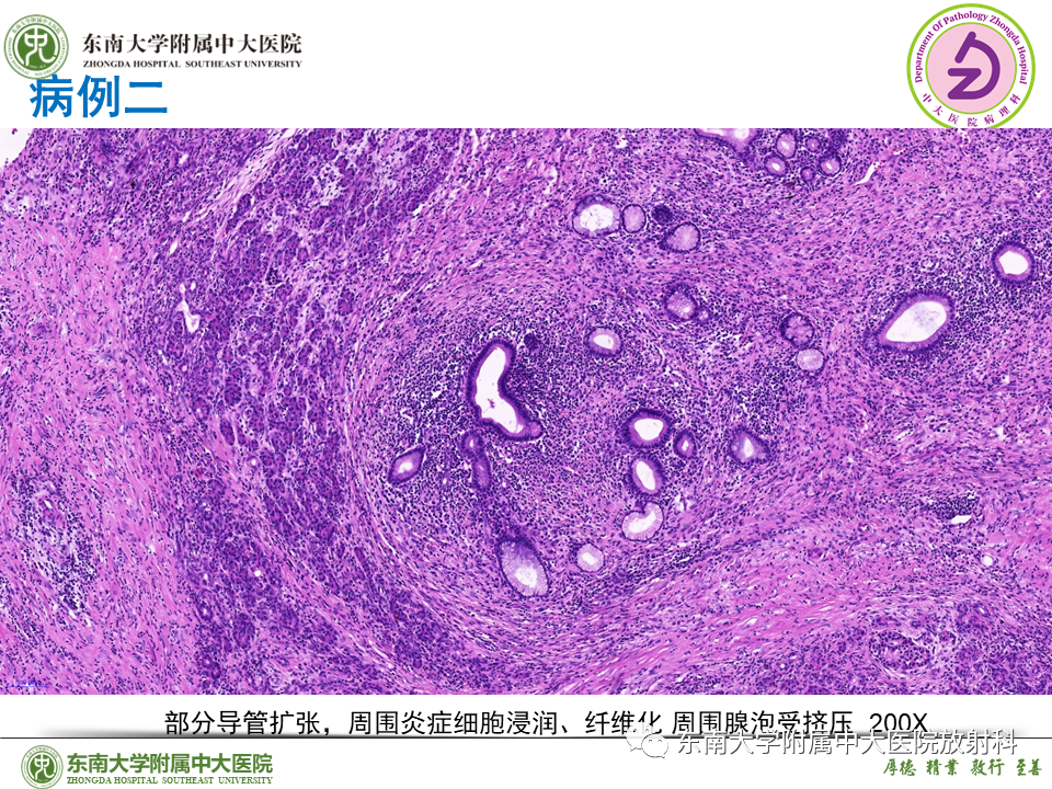 影像PPT - 【PPT】胰腺癌鉴别诊断-47 影像PPT - 【PPT】胰腺癌鉴别诊断-47