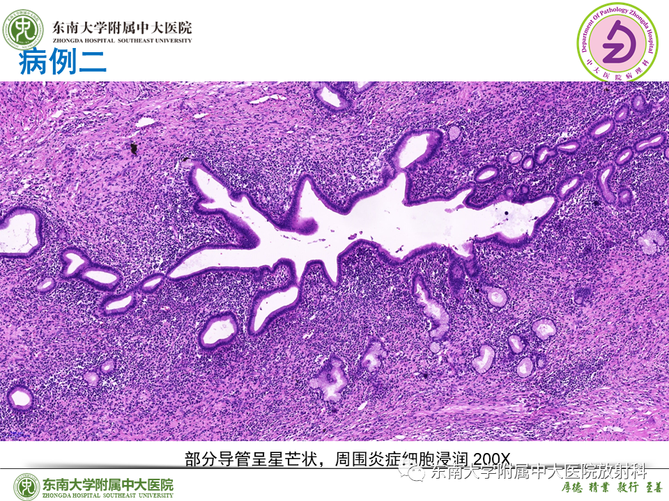 影像PPT - 【PPT】胰腺癌鉴别诊断-48 影像PPT - 【PPT】胰腺癌鉴别诊断-48