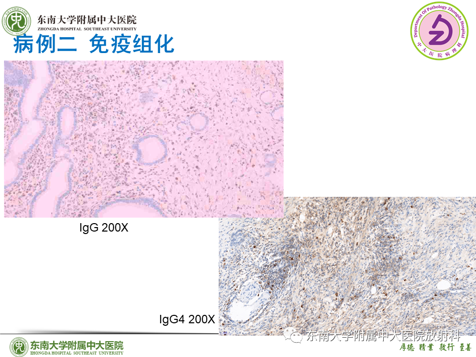 影像PPT - 【PPT】胰腺癌鉴别诊断-51 影像PPT - 【PPT】胰腺癌鉴别诊断-51