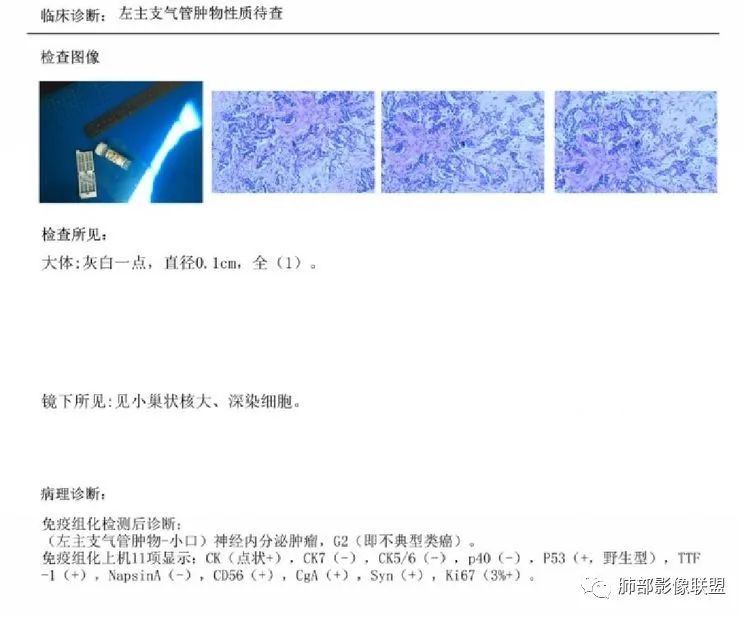 影像PPT - 【病例】年轻女性主支气管腔内结节-38 影像PPT - 【病例】年轻女性主支气管腔内结节-38