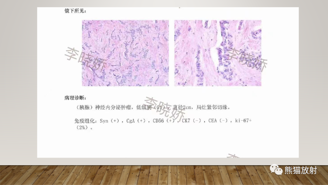影像PPT - 【PPT】胰腺神经内分泌肿瘤-4