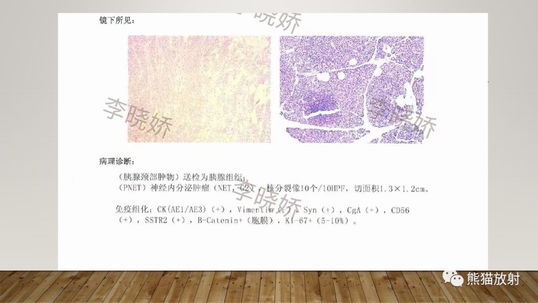 影像PPT - 【PPT】胰腺神经内分泌肿瘤-8