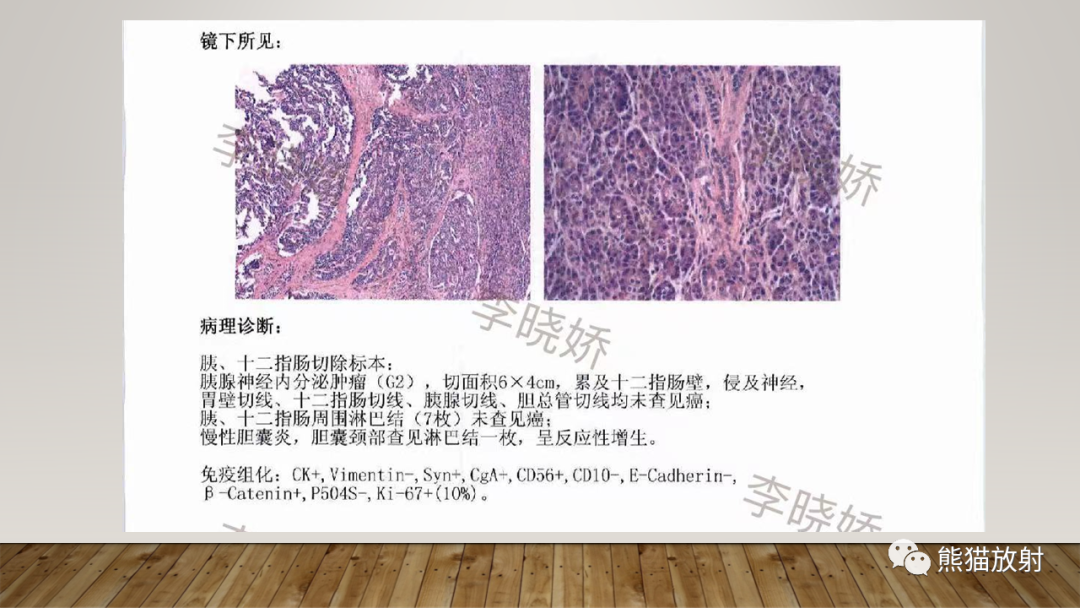 影像PPT - 【PPT】胰腺神经内分泌肿瘤-11