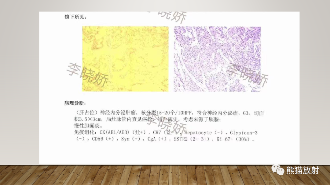 影像PPT - 【PPT】胰腺神经内分泌肿瘤-16