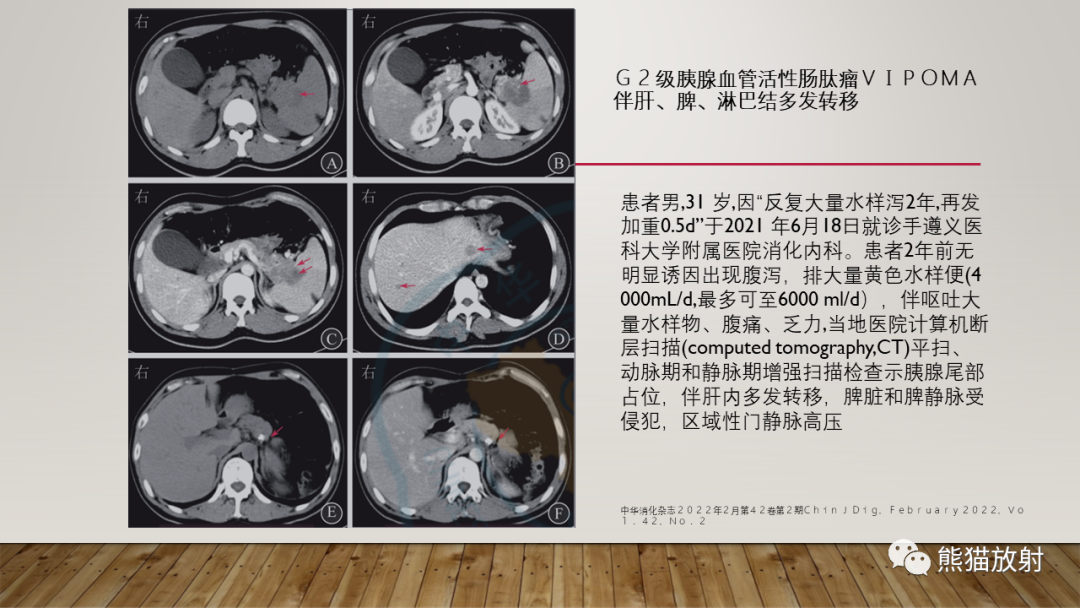 影像PPT - 【PPT】胰腺神经内分泌肿瘤-32
