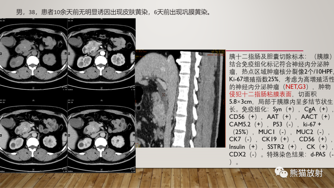 影像PPT - 【PPT】胰腺神经内分泌肿瘤-35