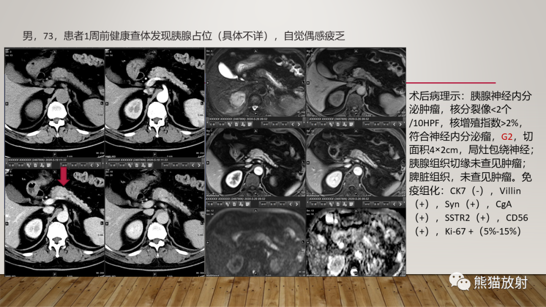 影像PPT - 【PPT】胰腺神经内分泌肿瘤-36