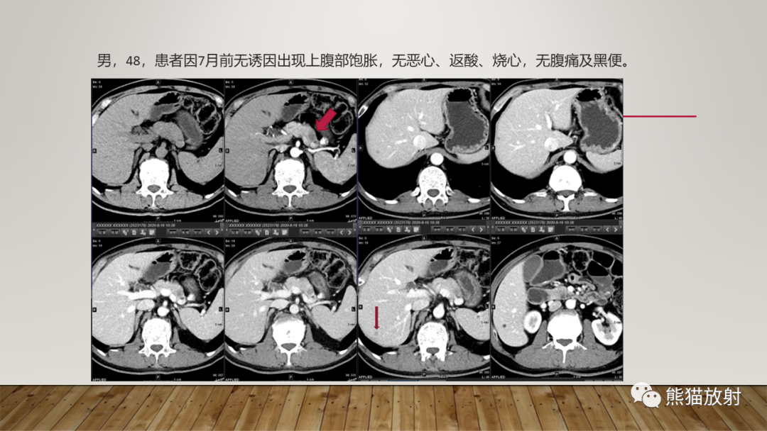 影像PPT - 【PPT】胰腺神经内分泌肿瘤-37