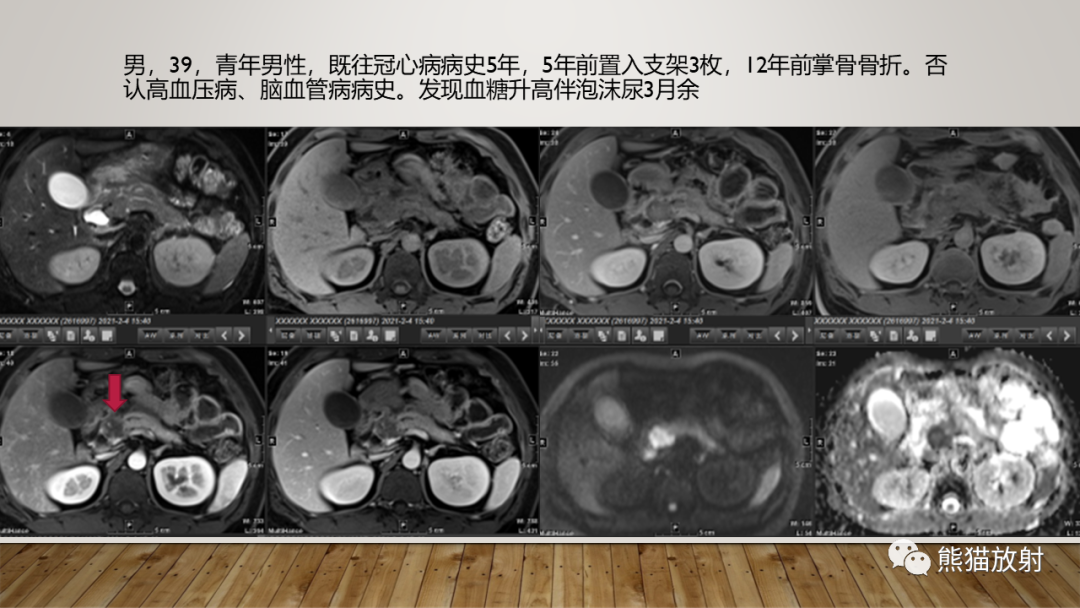 影像PPT - 【PPT】胰腺神经内分泌肿瘤-40