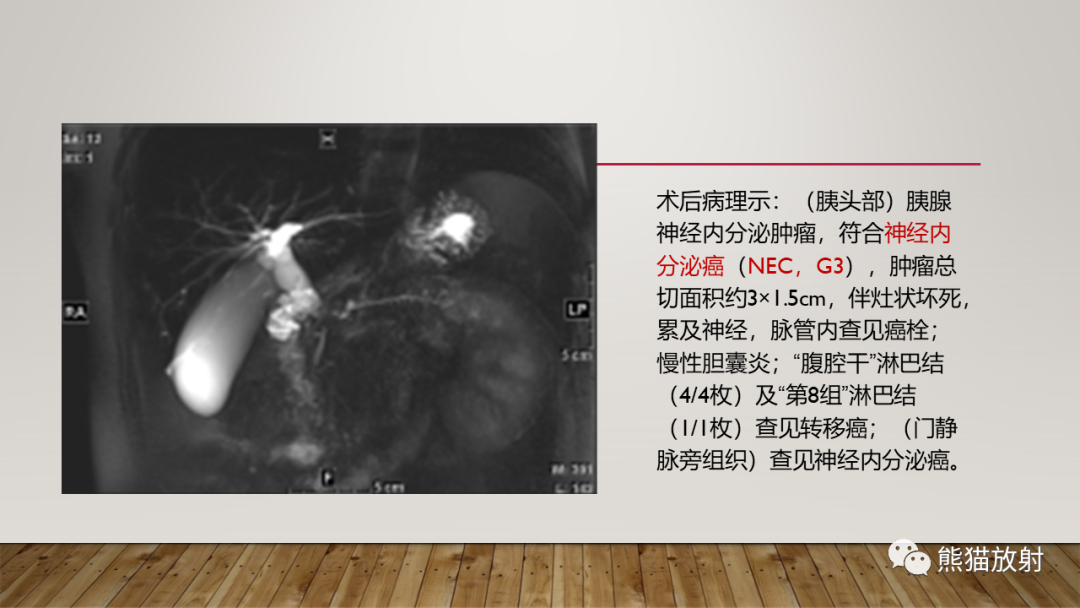 影像PPT - 【PPT】胰腺神经内分泌肿瘤-41