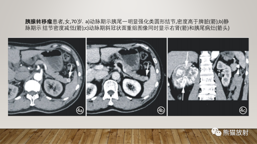 影像PPT - 【PPT】胰腺神经内分泌肿瘤-45