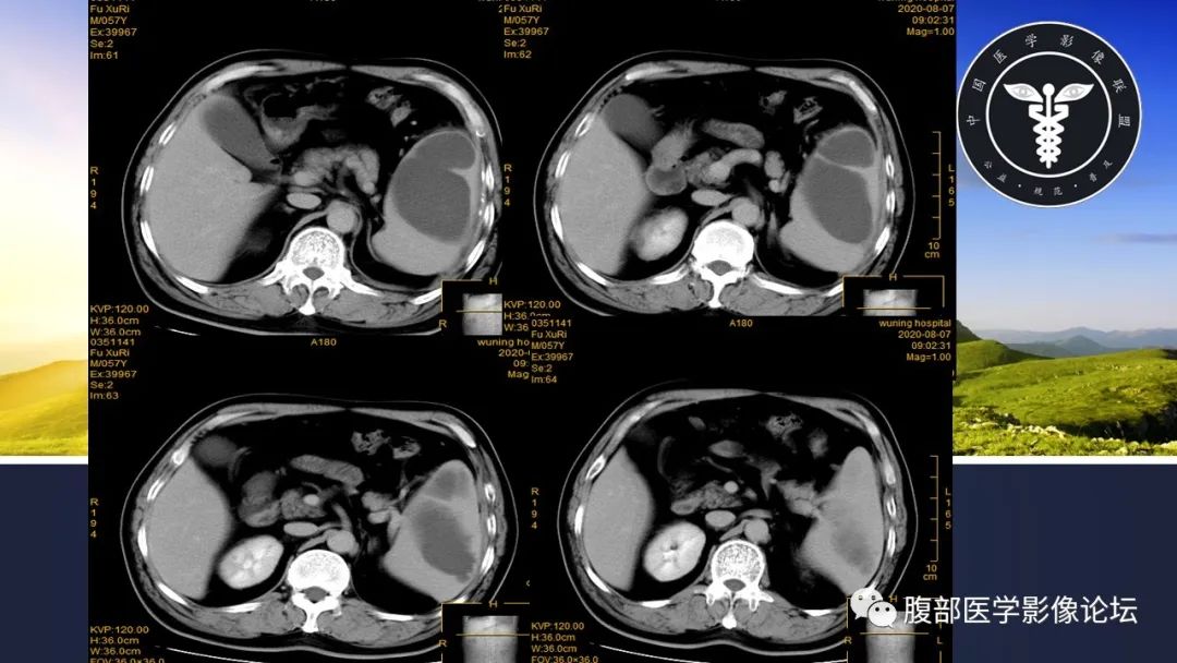 影像PPT - 【病例】脾脏脓肿1例CT影像-10 影像PPT - 【病例】脾脏脓肿1例CT影像-10