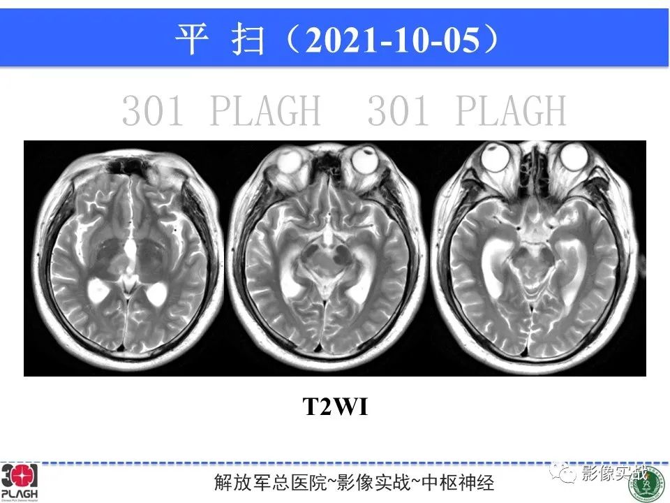 影像PPT - 【病例】中枢神经系统生殖细胞肿瘤1例MR-10