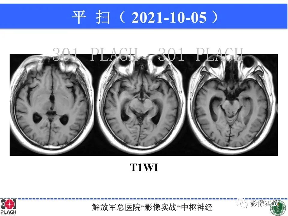 影像PPT - 【病例】中枢神经系统生殖细胞肿瘤1例MR-11