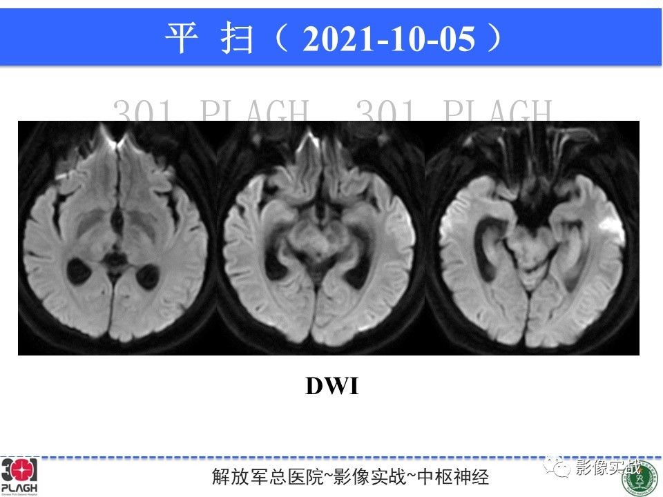 影像PPT - 【病例】中枢神经系统生殖细胞肿瘤1例MR-12