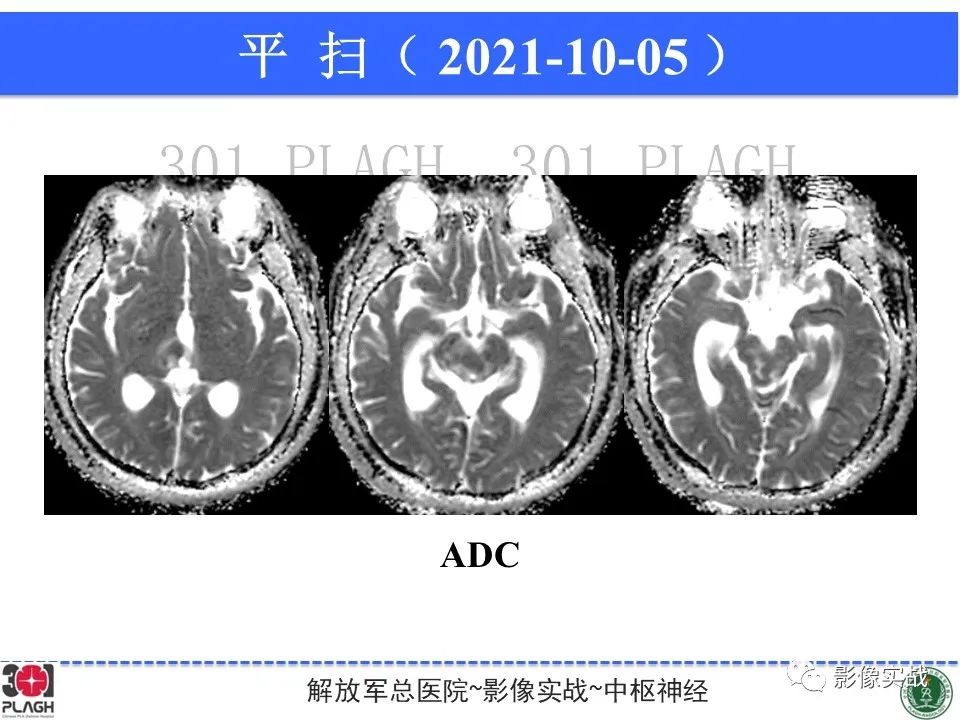 影像PPT - 【病例】中枢神经系统生殖细胞肿瘤1例MR-13