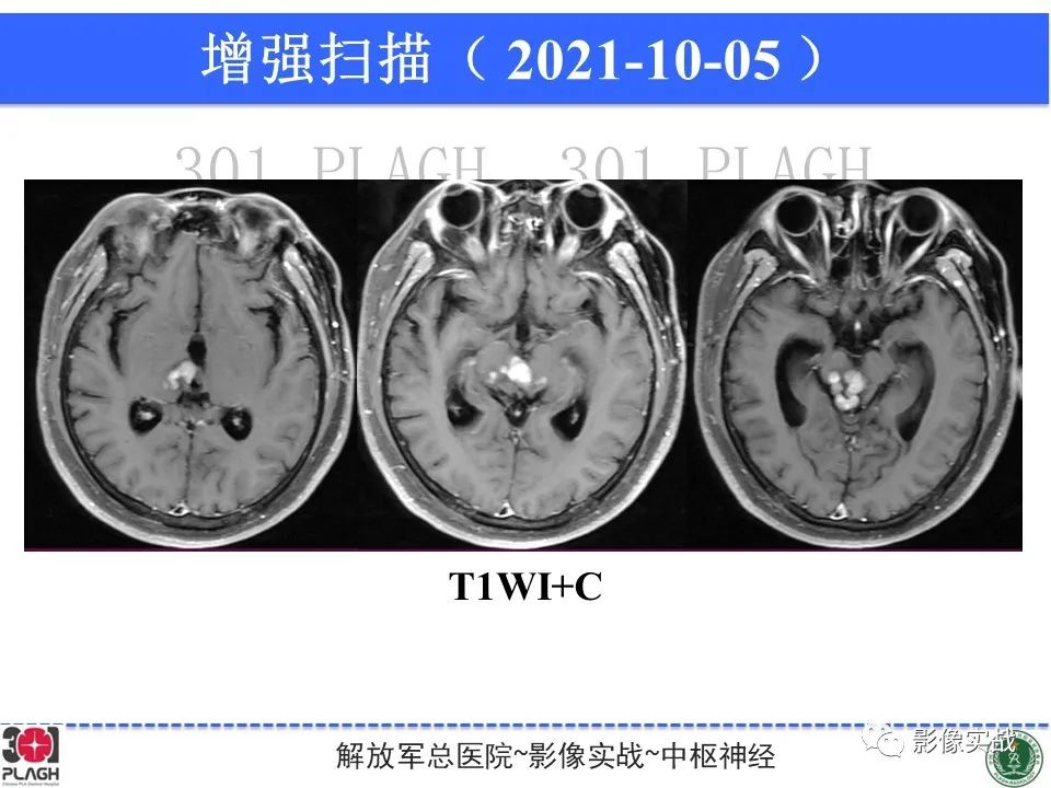 影像PPT - 【病例】中枢神经系统生殖细胞肿瘤1例MR-16