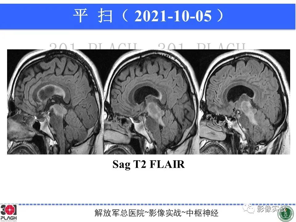 影像PPT - 【病例】中枢神经系统生殖细胞肿瘤1例MR-15