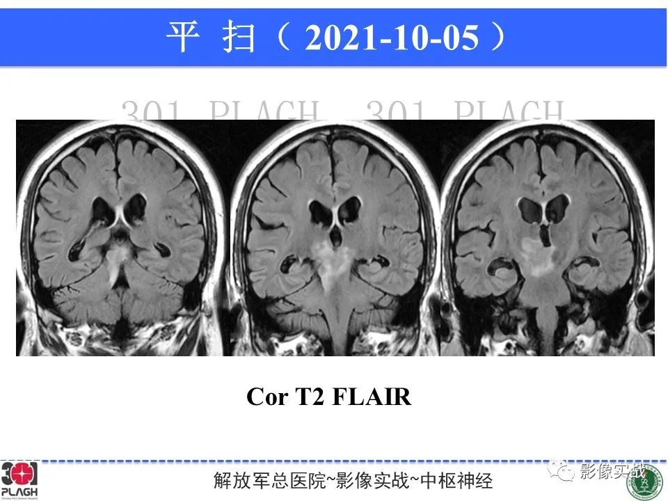 影像PPT - 【病例】中枢神经系统生殖细胞肿瘤1例MR-14