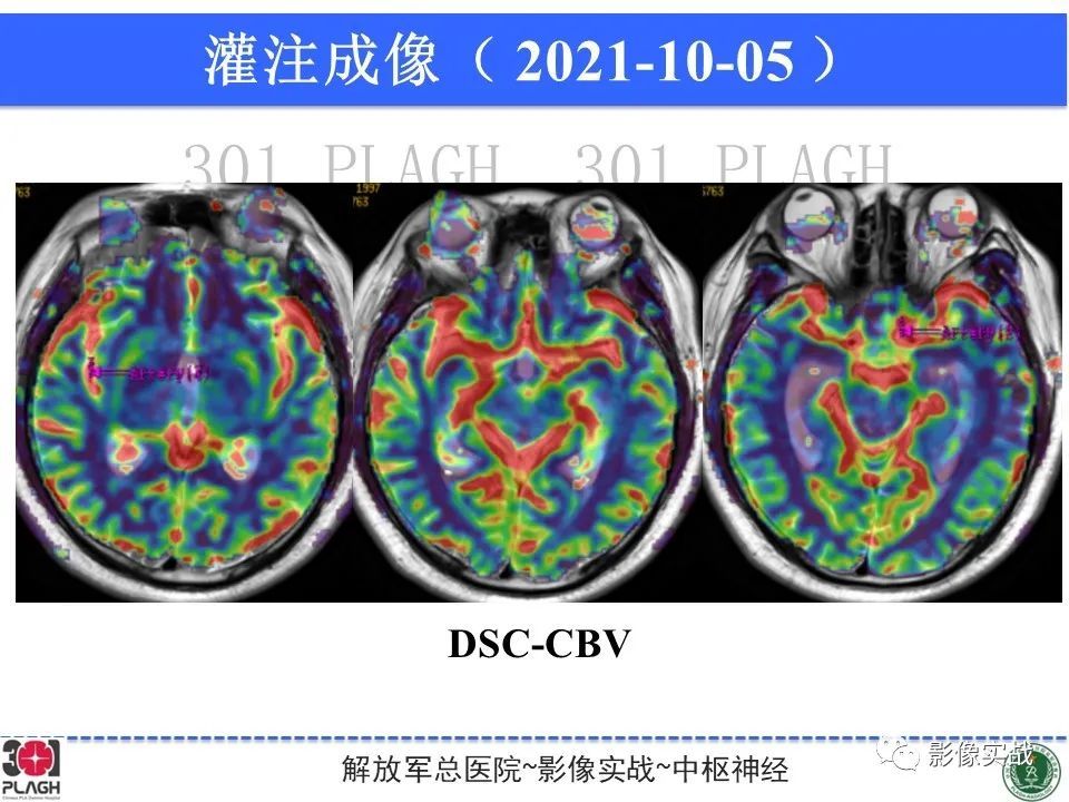 影像PPT - 【病例】中枢神经系统生殖细胞肿瘤1例MR-20