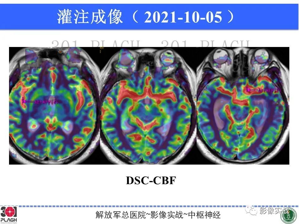 影像PPT - 【病例】中枢神经系统生殖细胞肿瘤1例MR-21