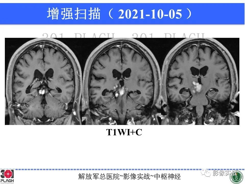 影像PPT - 【病例】中枢神经系统生殖细胞肿瘤1例MR-17
