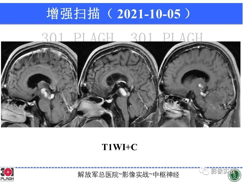 影像PPT - 【病例】中枢神经系统生殖细胞肿瘤1例MR-18