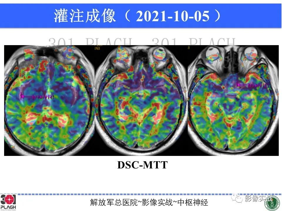 影像PPT - 【病例】中枢神经系统生殖细胞肿瘤1例MR-23