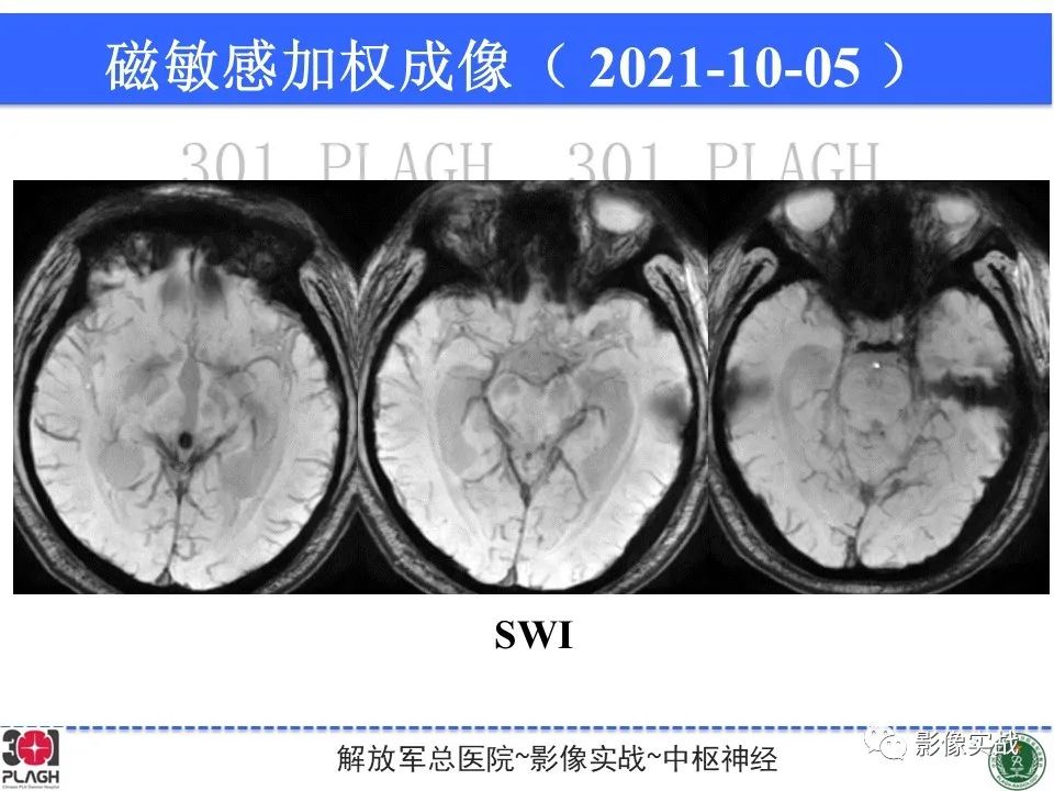影像PPT - 【病例】中枢神经系统生殖细胞肿瘤1例MR-24