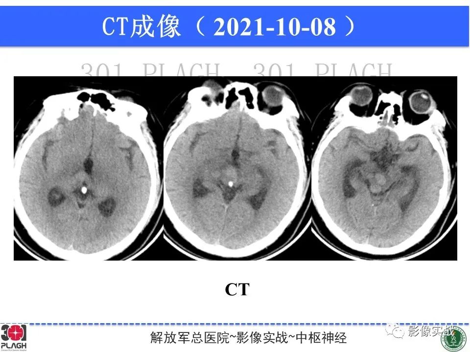 影像PPT - 【病例】中枢神经系统生殖细胞肿瘤1例MR-26