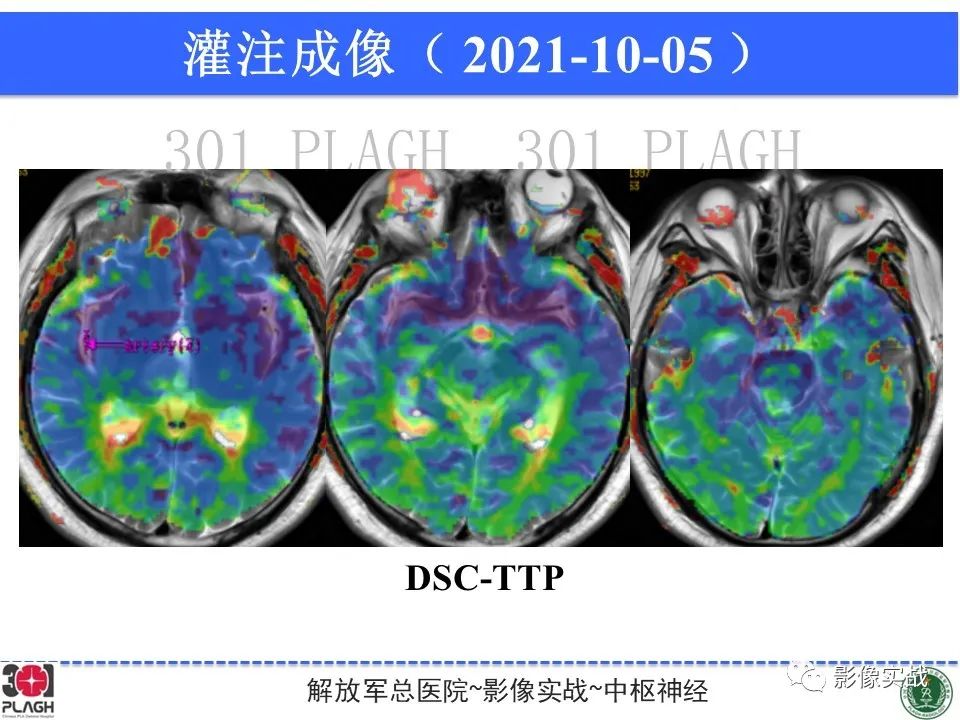 影像PPT - 【病例】中枢神经系统生殖细胞肿瘤1例MR-22