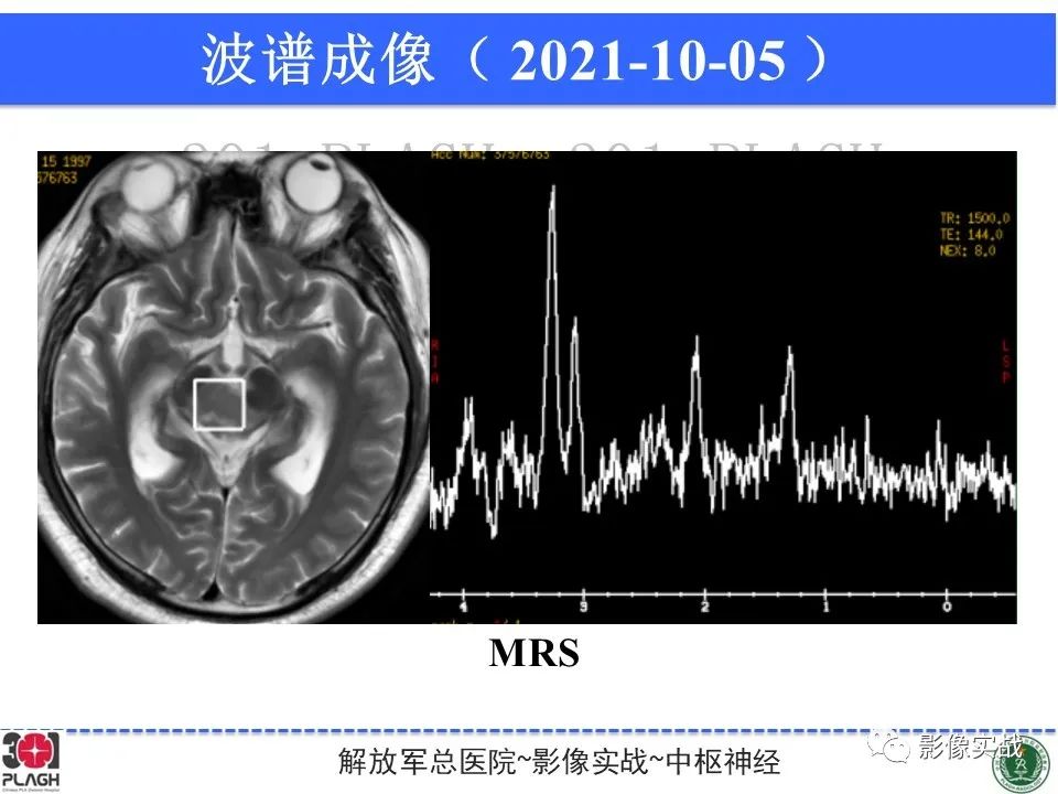 影像PPT - 【病例】中枢神经系统生殖细胞肿瘤1例MR-25