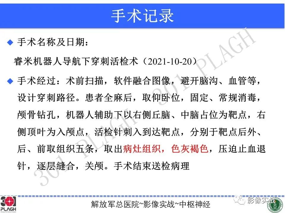 影像PPT - 【病例】中枢神经系统生殖细胞肿瘤1例MR-32