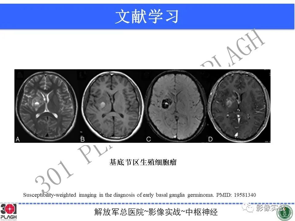 影像PPT - 【病例】中枢神经系统生殖细胞肿瘤1例MR-37