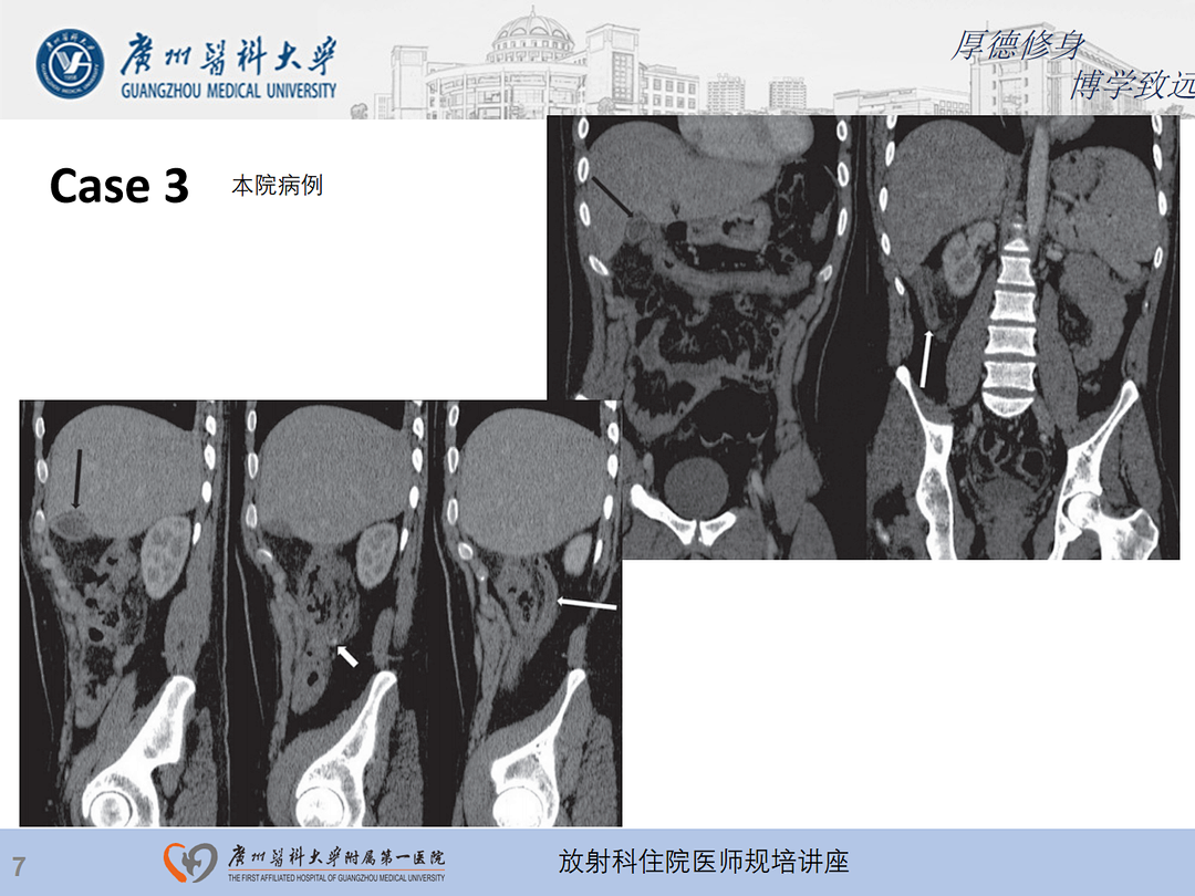 影像PPT - 【PPT】急性阑尾炎影像诊断思考和综述-8